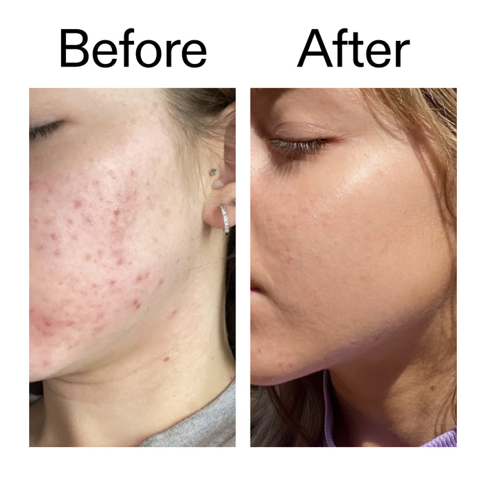 Before and after comparison of a person's face with acne on the left and clear skin on the right.